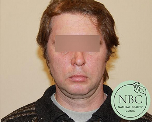 После: Отопластика