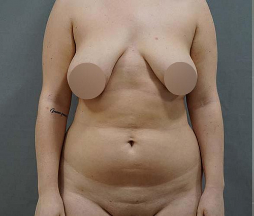 До: Липосакция