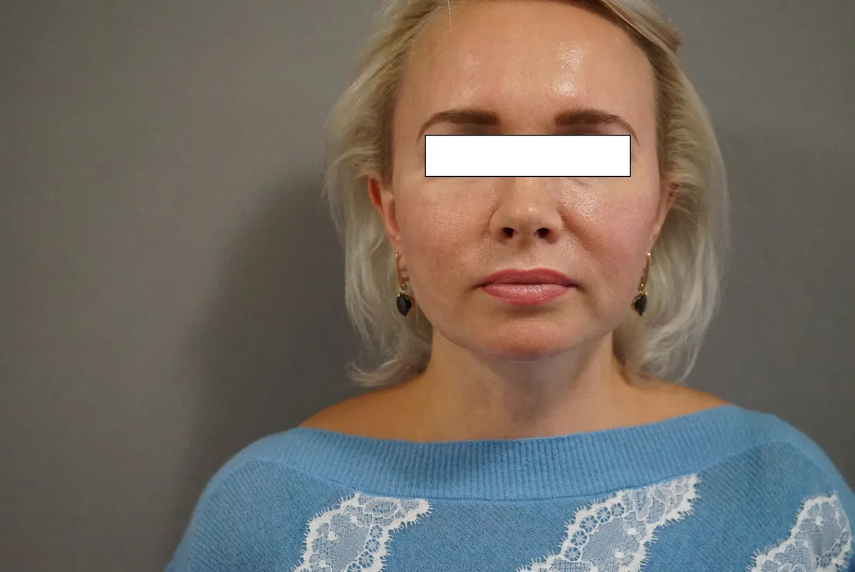 После: Лифтинг лица