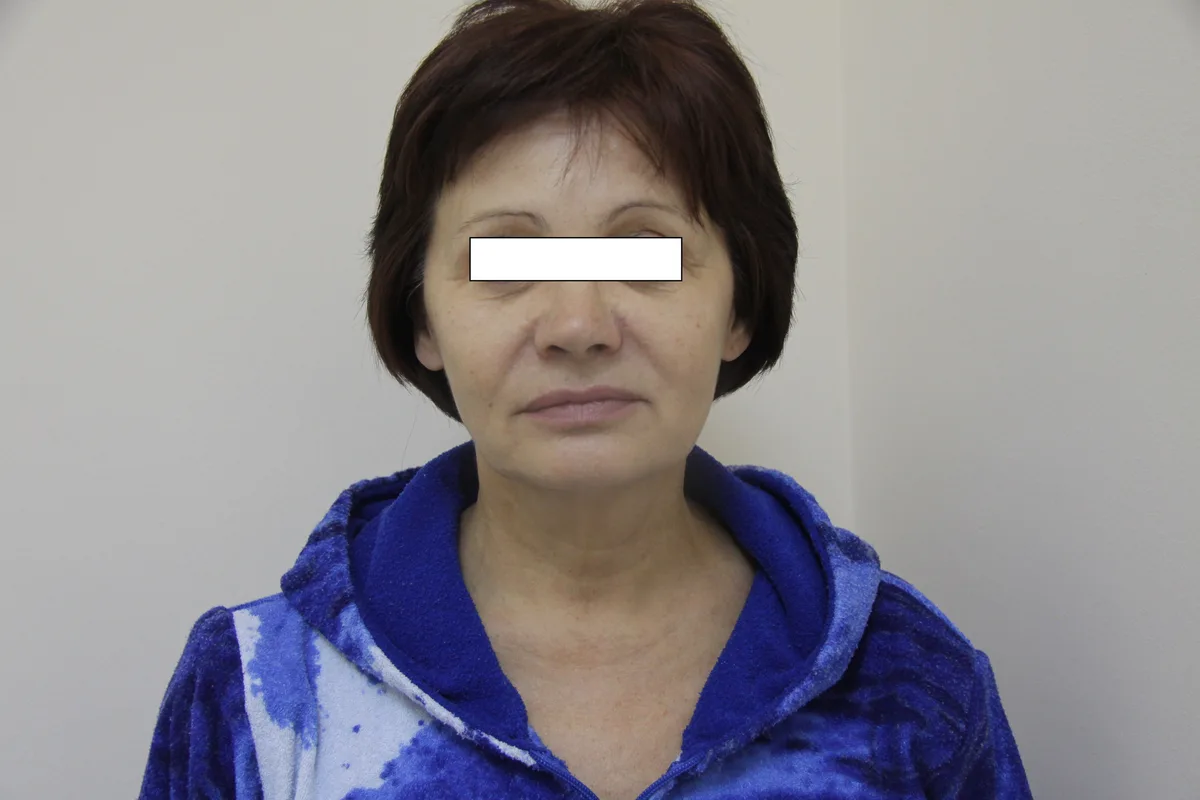 До: Лифтинг лица